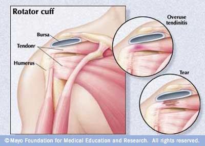 What are some symptoms of a shoulder tear?
